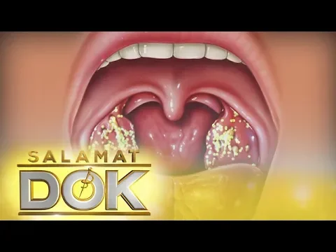 Salamat Dok: Information about tonsil stones