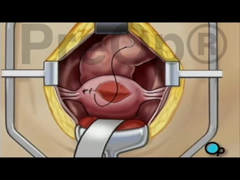 Myomectomy for Fibroids Surgery PreOp® Patient Education