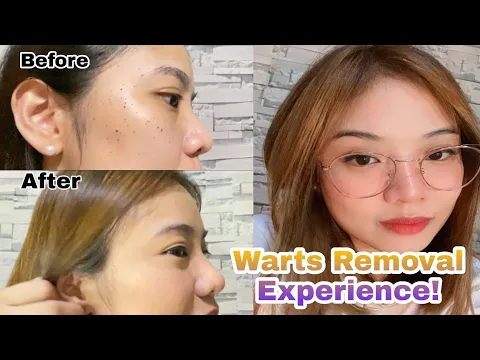 WARTS REMOVAL EXPERIENCE | PHILIPPINES | ANNE CURTEETH