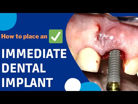 How is an IMMEDIATE DENTAL IMPLANT surgery done? #implants