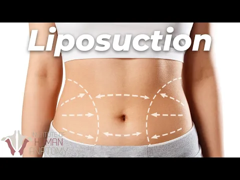 This Is What Happens During a Liposuction