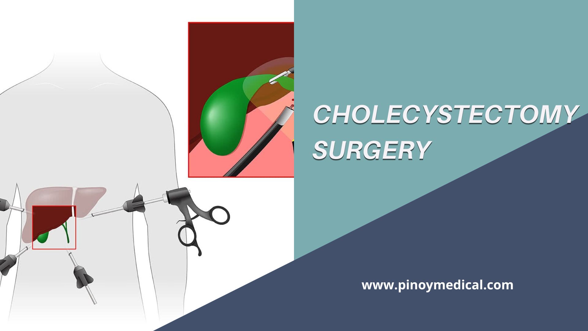 Cholecystectomy Surgery Price in the Philippines 2024 — PinoyMedical