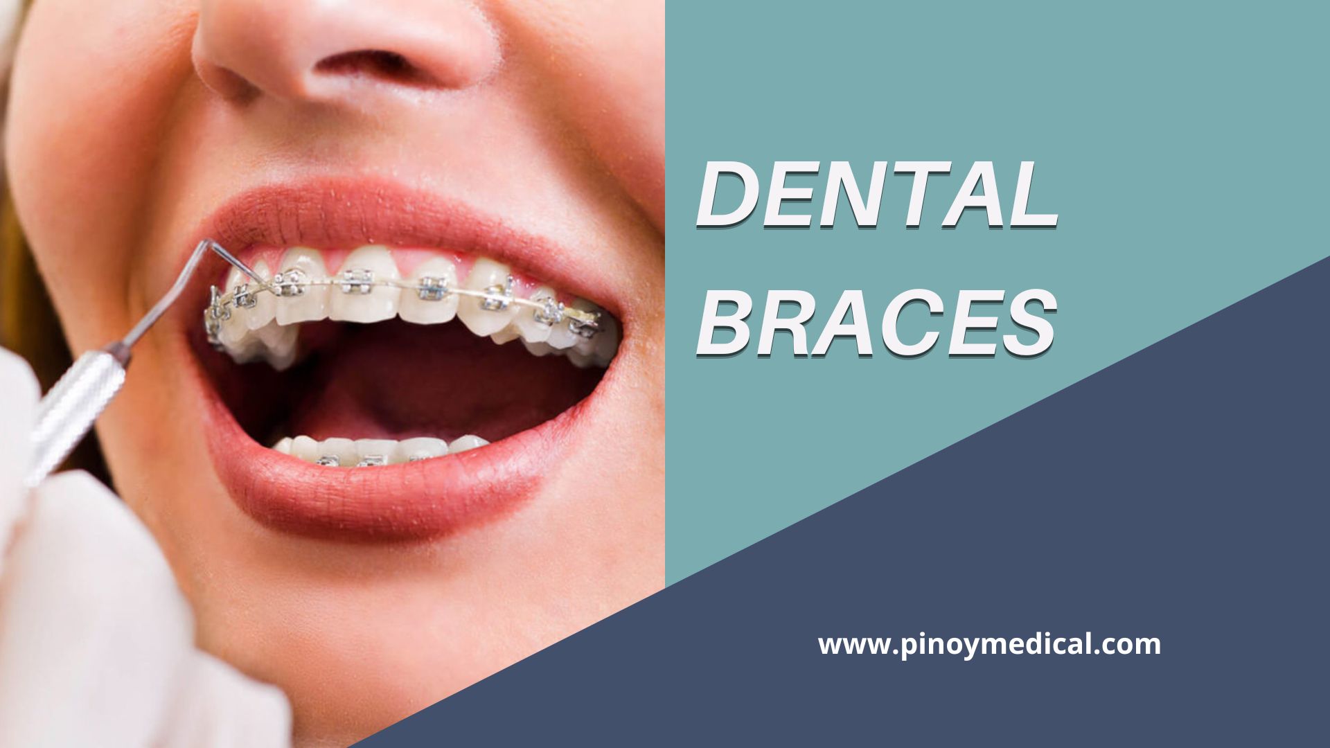 Dental Braces Price in the Philippines 2024 — PinoyMedical