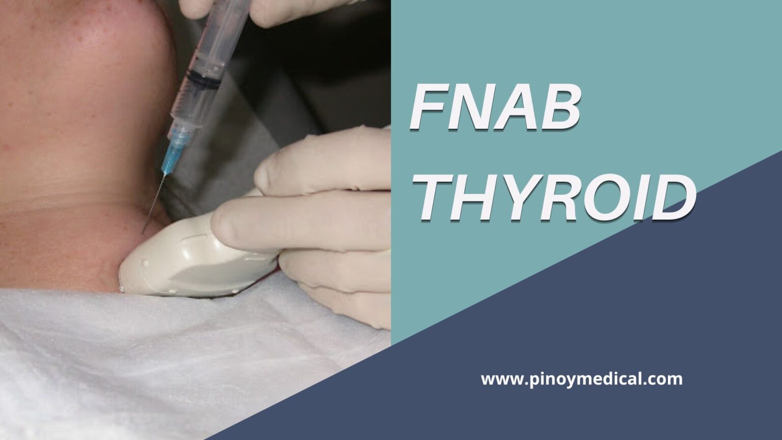 FNAB Thyroid Price in the Philippines 2025 — PinoyMedical