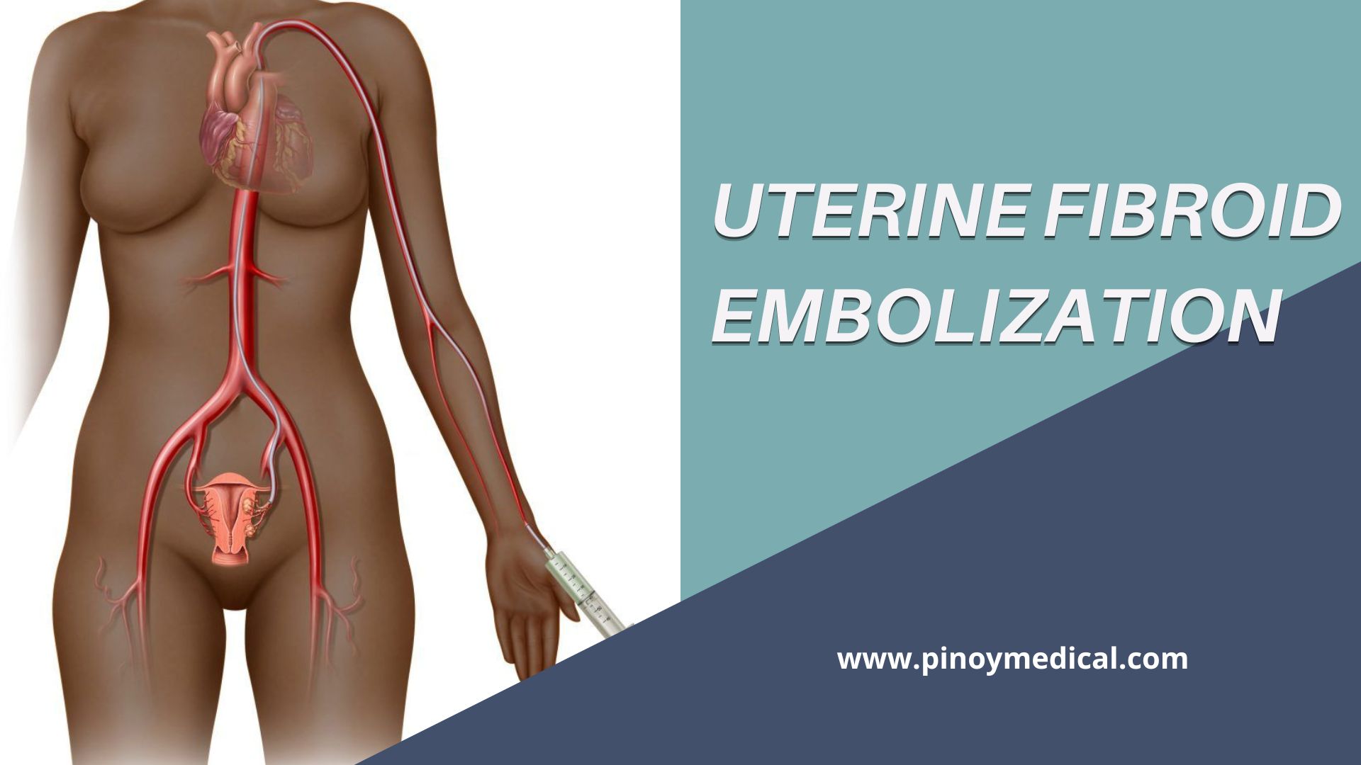 Uterine Fibroid Embolization Price In The Philippines Pinoymedical